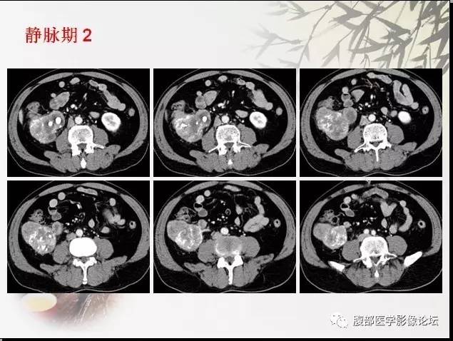 【病例】右肾骨外骨肉瘤1例CT 【病例】右肾骨外骨肉瘤1例CT