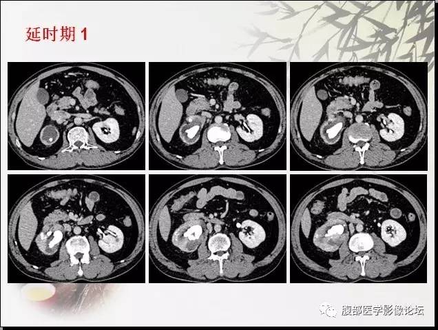 【病例】右肾骨外骨肉瘤1例CT 【病例】右肾骨外骨肉瘤1例CT
