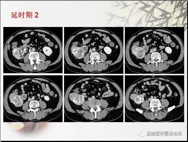 【病例】右肾骨外骨肉瘤1例CT 【病例】右肾骨外骨肉瘤1例CT
