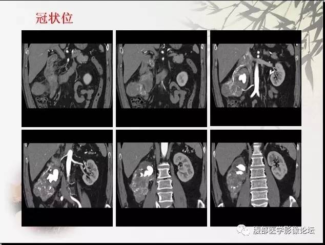 【病例】右肾骨外骨肉瘤1例CT 【病例】右肾骨外骨肉瘤1例CT