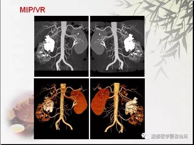【病例】右肾骨外骨肉瘤1例CT 【病例】右肾骨外骨肉瘤1例CT