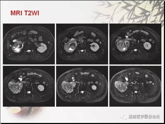 【病例】右肾骨外骨肉瘤1例CT 【病例】右肾骨外骨肉瘤1例CT