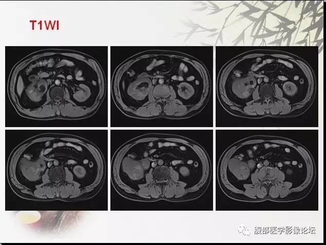 【病例】右肾骨外骨肉瘤1例CT 【病例】右肾骨外骨肉瘤1例CT