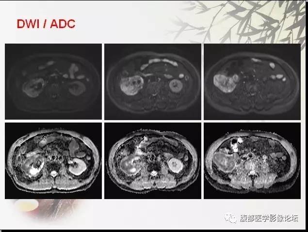【病例】右肾骨外骨肉瘤1例CT 【病例】右肾骨外骨肉瘤1例CT