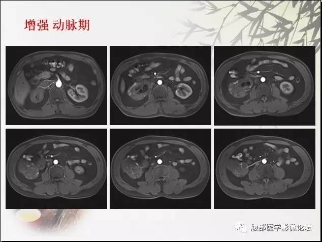 【病例】右肾骨外骨肉瘤1例CT 【病例】右肾骨外骨肉瘤1例CT