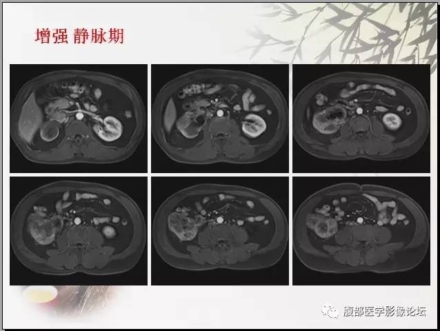 【病例】右肾骨外骨肉瘤1例CT 【病例】右肾骨外骨肉瘤1例CT