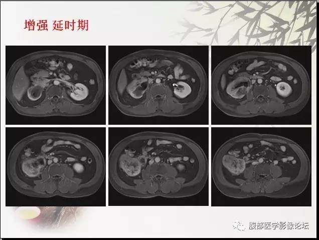 【病例】右肾骨外骨肉瘤1例CT 【病例】右肾骨外骨肉瘤1例CT