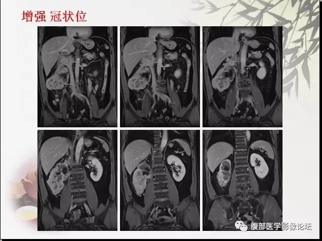 【病例】右肾骨外骨肉瘤1例CT 【病例】右肾骨外骨肉瘤1例CT