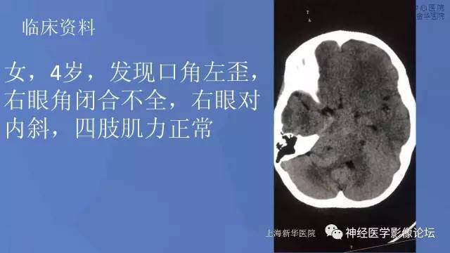 【病例】右桥小脑角区小细胞胚胎性肿瘤1例CT及MR