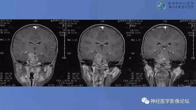 【病例】右桥小脑角区小细胞胚胎性肿瘤1例CT及MR