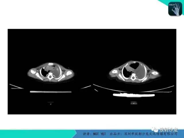 【病例】左胸腔脂肪母细胞瘤1例CT 【病例】左胸腔脂肪母细胞瘤1例CT