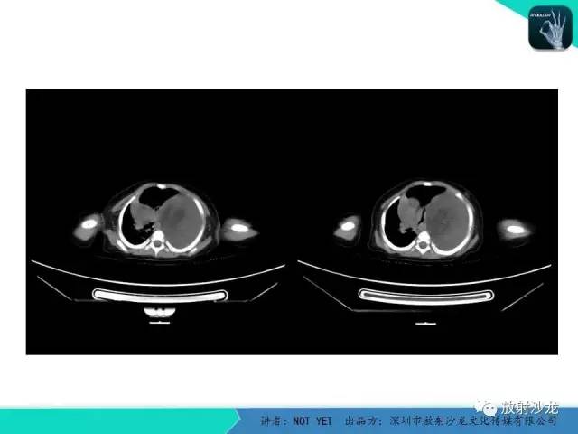 【病例】左胸腔脂肪母细胞瘤1例CT