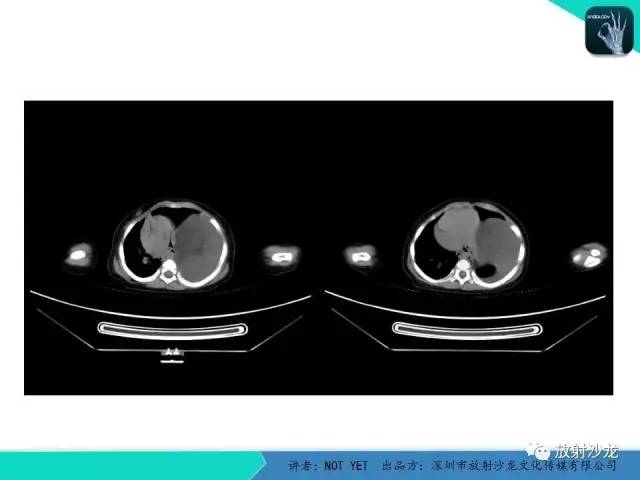 【病例】左胸腔脂肪母细胞瘤1例CT 【病例】左胸腔脂肪母细胞瘤1例CT