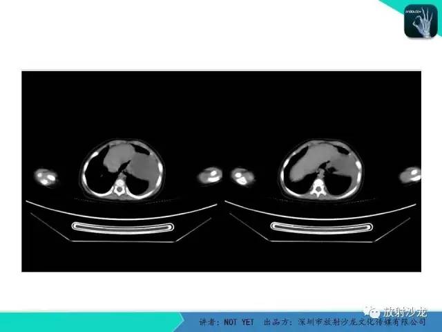 【病例】左胸腔脂肪母细胞瘤1例CT 【病例】左胸腔脂肪母细胞瘤1例CT