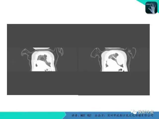 【病例】左胸腔脂肪母细胞瘤1例CT 【病例】左胸腔脂肪母细胞瘤1例CT