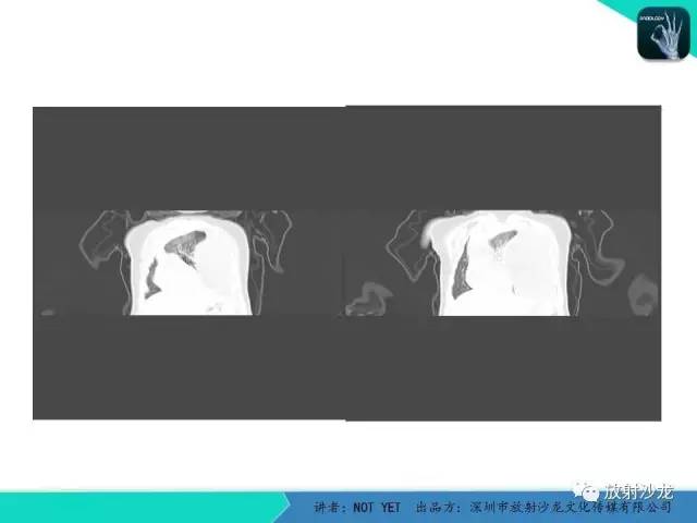 【病例】左胸腔脂肪母细胞瘤1例CT 【病例】左胸腔脂肪母细胞瘤1例CT