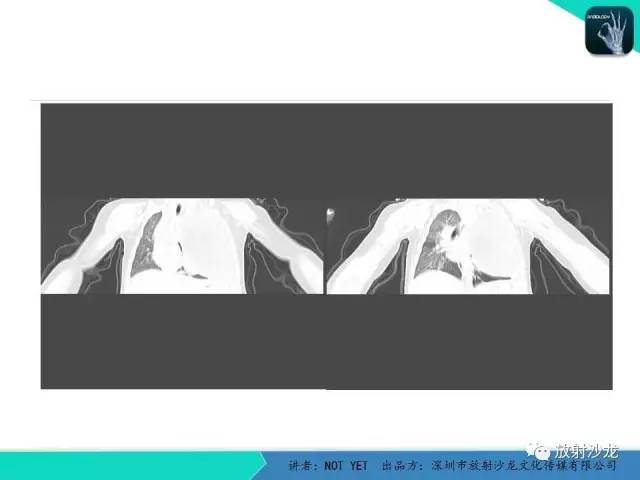 【病例】左胸腔脂肪母细胞瘤1例CT 【病例】左胸腔脂肪母细胞瘤1例CT