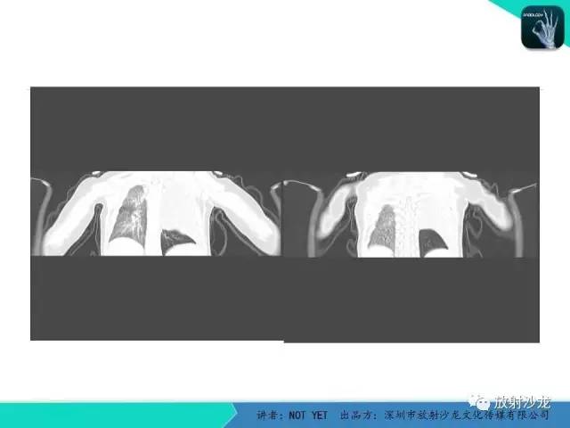 【病例】左胸腔脂肪母细胞瘤1例CT 【病例】左胸腔脂肪母细胞瘤1例CT
