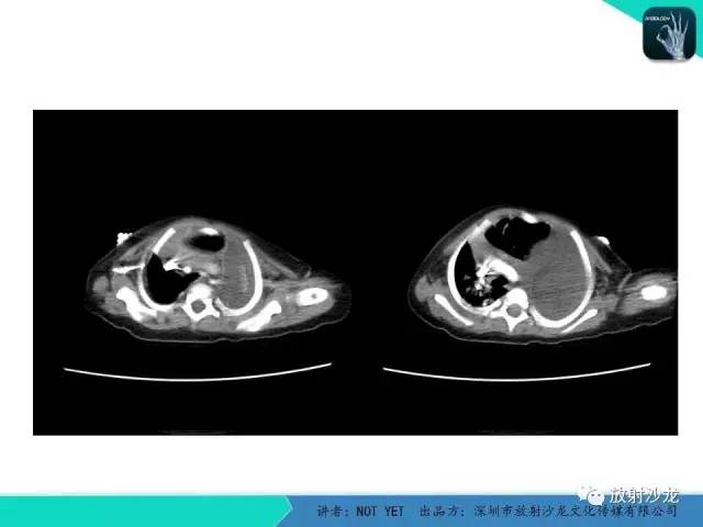 【病例】左胸腔脂肪母细胞瘤1例CT 【病例】左胸腔脂肪母细胞瘤1例CT