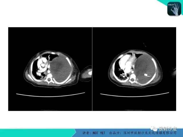 【病例】左胸腔脂肪母细胞瘤1例CT 【病例】左胸腔脂肪母细胞瘤1例CT