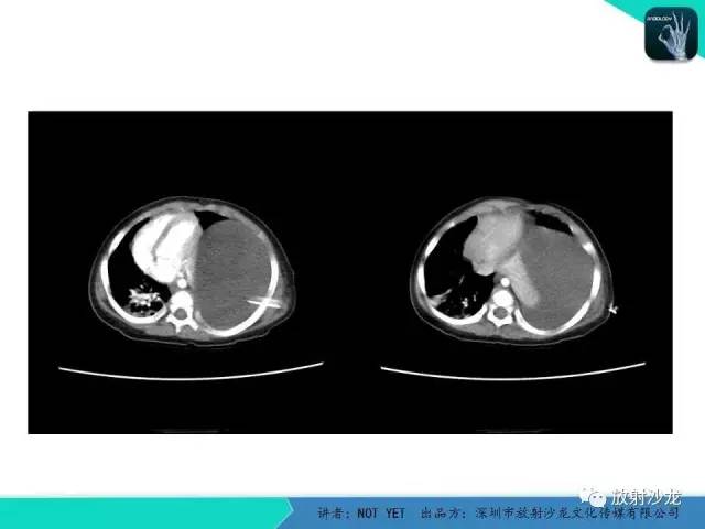 【病例】左胸腔脂肪母细胞瘤1例CT 【病例】左胸腔脂肪母细胞瘤1例CT