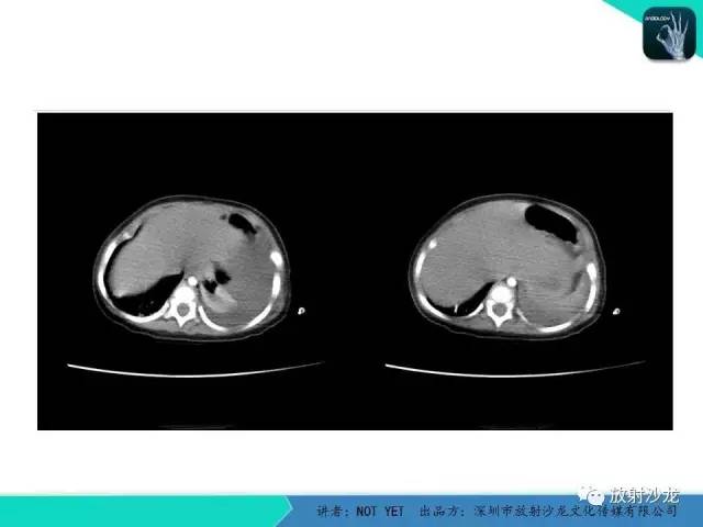 【病例】左胸腔脂肪母细胞瘤1例CT 【病例】左胸腔脂肪母细胞瘤1例CT