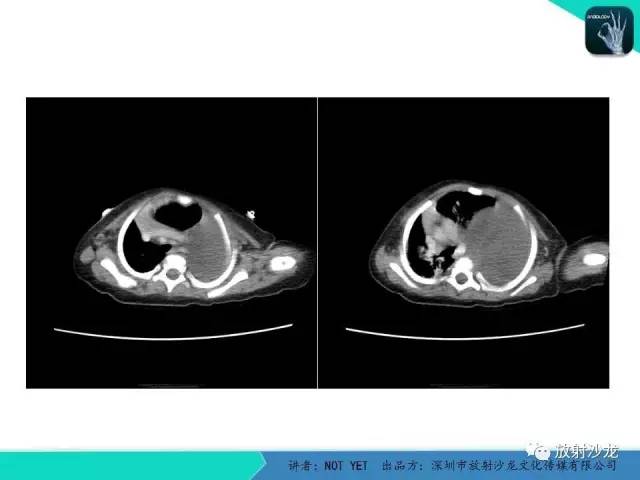 【病例】左胸腔脂肪母细胞瘤1例CT 【病例】左胸腔脂肪母细胞瘤1例CT