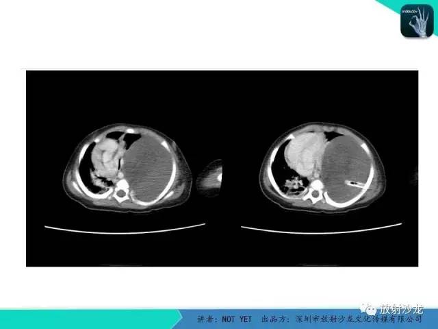 【病例】左胸腔脂肪母细胞瘤1例CT 【病例】左胸腔脂肪母细胞瘤1例CT