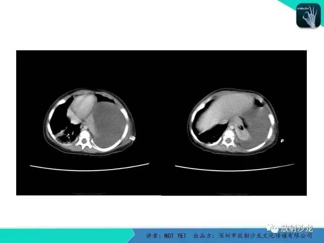 【病例】左胸腔脂肪母细胞瘤1例CT 【病例】左胸腔脂肪母细胞瘤1例CT