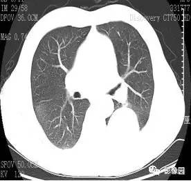 【病例】胸膜孤立性纤维瘤1例CT影像表现