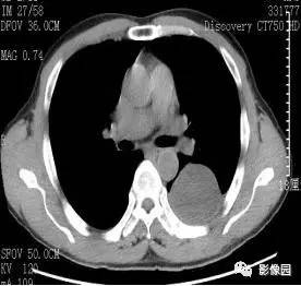 【病例】胸膜孤立性纤维瘤1例CT影像表现