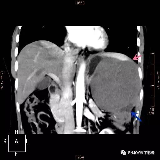 手把手教你会读片——典型脾脏淋巴瘤 手把手教你会读片——典型脾脏淋巴瘤