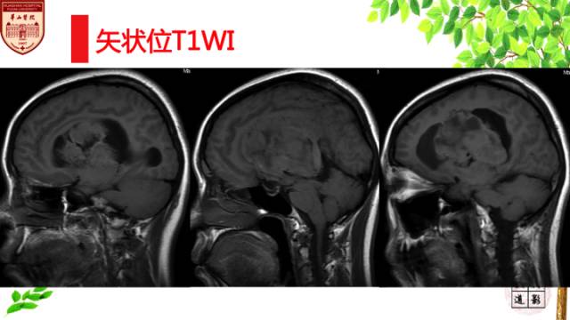 【病例】中枢神经细胞瘤1例MR影像表现 【病例】中枢神经细胞瘤1例MR影像表现