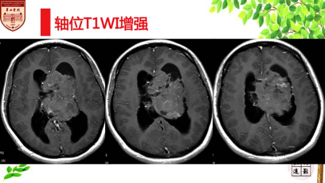【病例】中枢神经细胞瘤1例MR影像表现 【病例】中枢神经细胞瘤1例MR影像表现