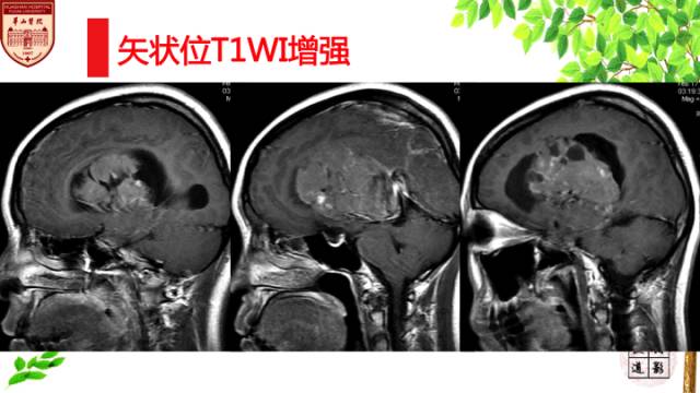 【病例】中枢神经细胞瘤1例MR影像表现 【病例】中枢神经细胞瘤1例MR影像表现