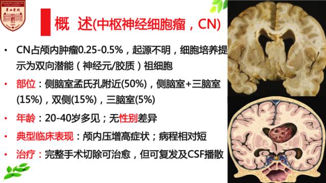 【病例】中枢神经细胞瘤1例MR影像表现 【病例】中枢神经细胞瘤1例MR影像表现