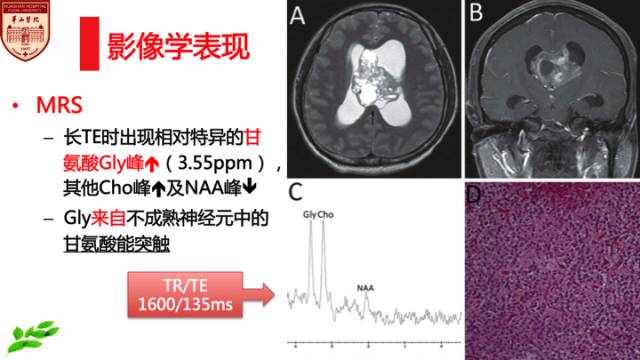 【病例】中枢神经细胞瘤1例MR影像表现 【病例】中枢神经细胞瘤1例MR影像表现