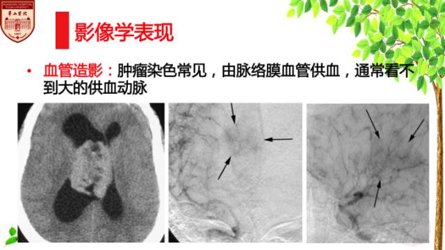 【病例】中枢神经细胞瘤1例MR影像表现 【病例】中枢神经细胞瘤1例MR影像表现