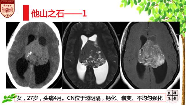 【病例】中枢神经细胞瘤1例MR影像表现 【病例】中枢神经细胞瘤1例MR影像表现