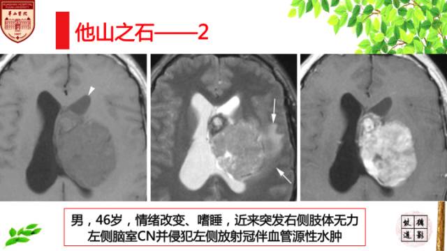 【病例】中枢神经细胞瘤1例MR影像表现 【病例】中枢神经细胞瘤1例MR影像表现