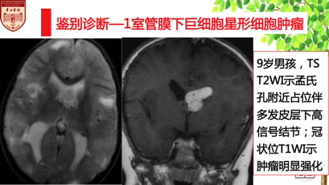【病例】中枢神经细胞瘤1例MR影像表现 【病例】中枢神经细胞瘤1例MR影像表现