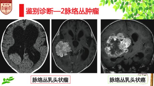 【病例】中枢神经细胞瘤1例MR影像表现 【病例】中枢神经细胞瘤1例MR影像表现
