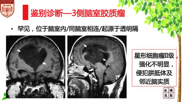 【病例】中枢神经细胞瘤1例MR影像表现 【病例】中枢神经细胞瘤1例MR影像表现