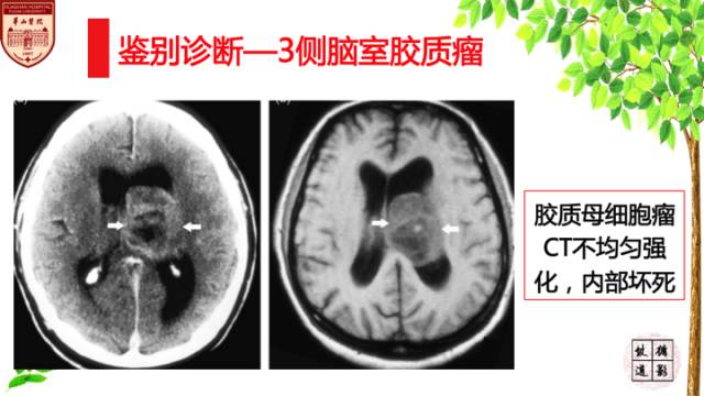 【病例】中枢神经细胞瘤1例MR影像表现 【病例】中枢神经细胞瘤1例MR影像表现