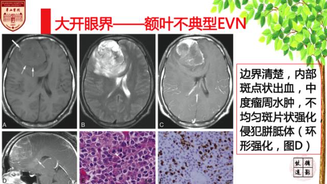 【病例】中枢神经细胞瘤1例MR影像表现 【病例】中枢神经细胞瘤1例MR影像表现