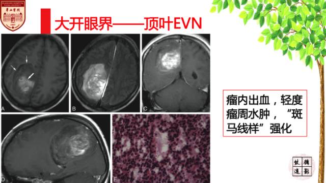 【病例】中枢神经细胞瘤1例MR影像表现 【病例】中枢神经细胞瘤1例MR影像表现