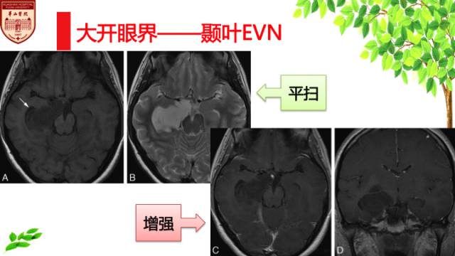 【病例】中枢神经细胞瘤1例MR影像表现 【病例】中枢神经细胞瘤1例MR影像表现