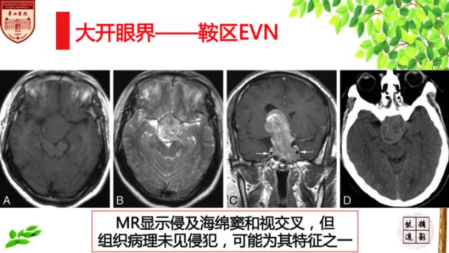 【病例】中枢神经细胞瘤1例MR影像表现 【病例】中枢神经细胞瘤1例MR影像表现