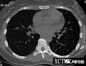 【病例】肺泡微结石症1例CT影像表现 【病例】肺泡微结石症1例CT影像表现