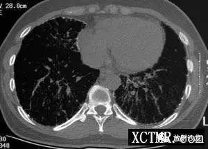 【病例】肺泡微结石症1例CT影像表现 【病例】肺泡微结石症1例CT影像表现